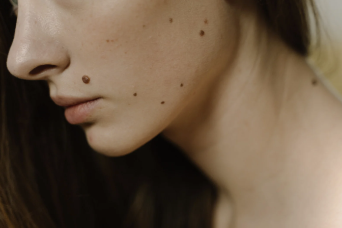 Face Moles